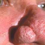 Τι είναι το ρινόφυμα;