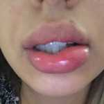 Το εμβόλιο Moderna μπορεί να προκαλέσει προσωρινό πρήξιμο σε όσους έχουν κάνει μπότοξ ή υαλουρονικό